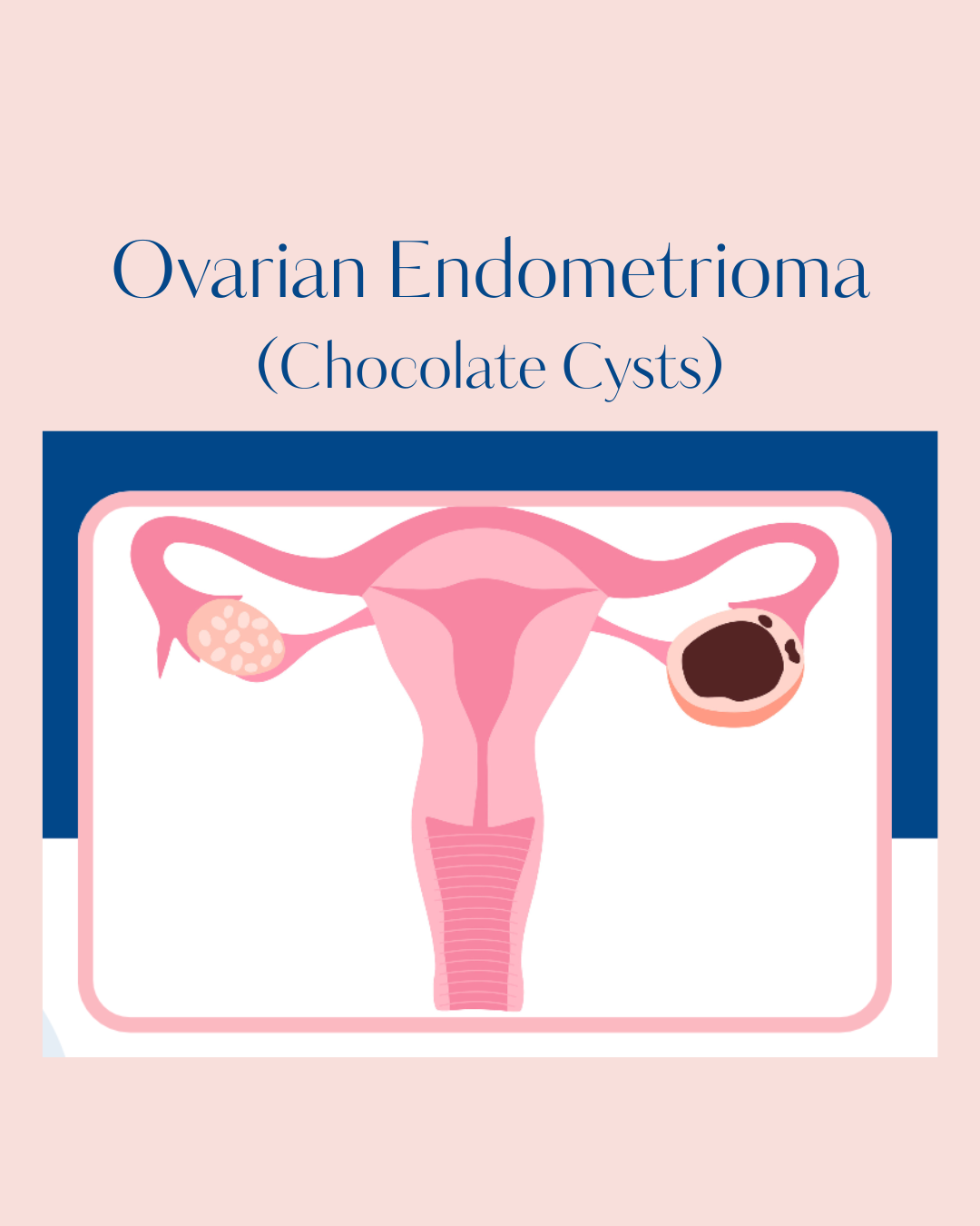 thumbnail of Ovarian Endometrioma by Smita Ektare