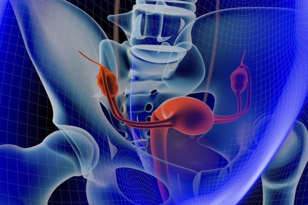Bilateral salpingectomy – removal of the fallopian tubes – can reduce ovarian cancer risk by about 80%